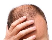 Dlaczego niscy mężczyźni łysieją częściej?	