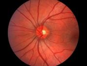 Wytyczne dotyczące retinopatii cukrzycowej i...