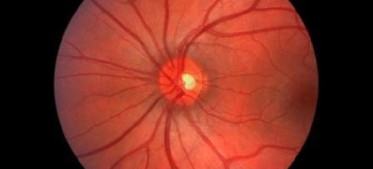 Wytyczne dotyczące retinopatii cukrzycowej i makulopatii