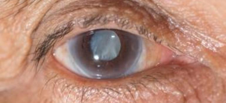 Polski Związek Niewidomych stanowczo sprzeciwia się ograniczaniu dostępu do leczenia zaćmy