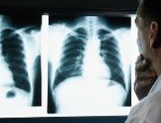 Eksperci: Rak płuca wymaga szybkich i...